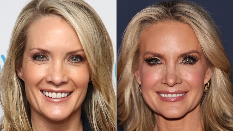 Dana Perino posando para una foto en 2016, antes de las acusaciones de cirugía plástica, y Dana Perino en 2024 después de las acusaciones de cirugía plástica.