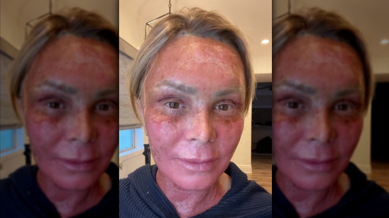 Tamra Judge documenta la recuperación de su procedimiento