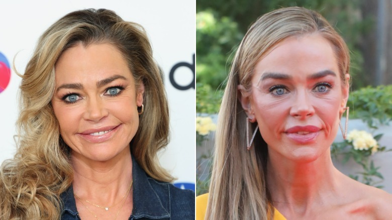 Fotos una al lado de la otra que muestran la transformación del rostro de Denise Richards después de un lavado de cara