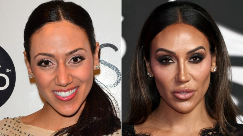 Fotos lado a lado que muestran la cirugía plástica de Melissa Gorga