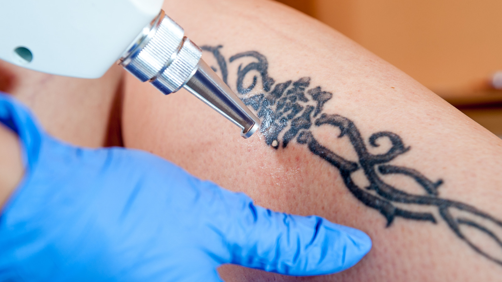 A los millennials les encantaban los tatuajes; ahora están haciendo de la eliminación con láser la próxima gran tendencia